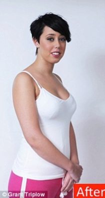 Stem Cells Breast Enhancement After Picture